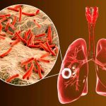 Estudian cómo mejorar el tratamiento de tuberculosis con antiinflamatorios oms