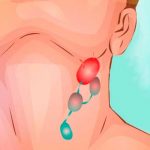 Día Mundial del Linfoma: Causas, síntomas y tratamientos salud