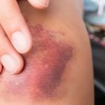 Si te aparecen moretones con frecuencia, esto podría estar padeciendo salud