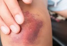 Si te aparecen moretones con frecuencia, esto podría estar padeciendo salud