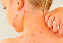 ¿El sarampión es muy contagioso? aquí los detalles salud