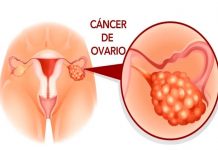 Cáncer de ovario: La enfermedad que mató a Edith González cancer de ovarios