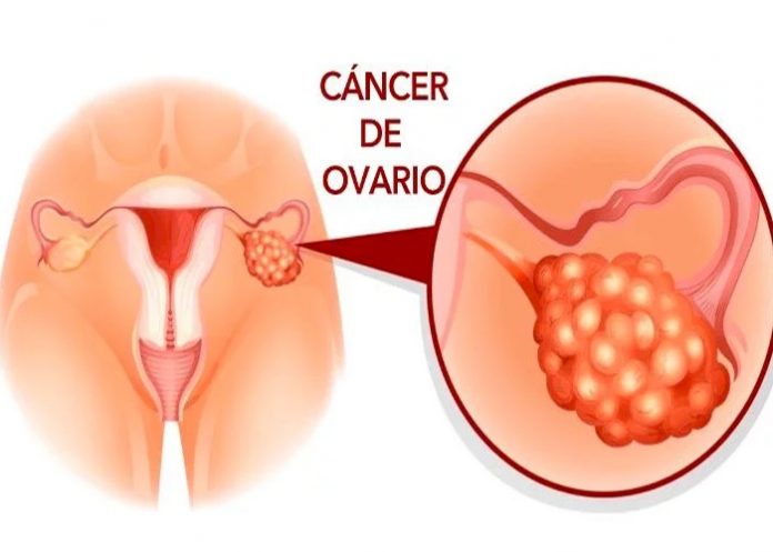 cancer de ovarios