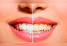 ¿Qué alimentos manchan tus dientes? salud