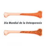 osteoporosis
