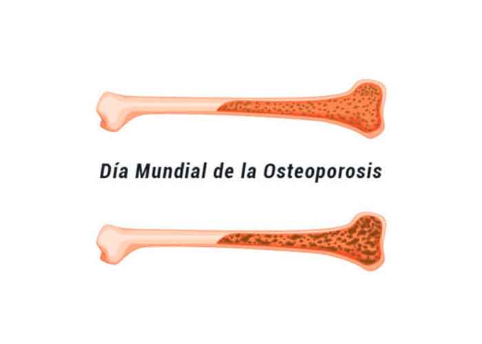 7.1_3RkPHmT osteoporosis