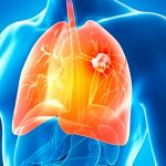 Tratamiento para cáncer de pulmón reduce un 50% riesgo de muerte cancer de pulmon