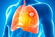 Tratamiento para cáncer de pulmón reduce un 50% riesgo de muerte cancer de pulmon