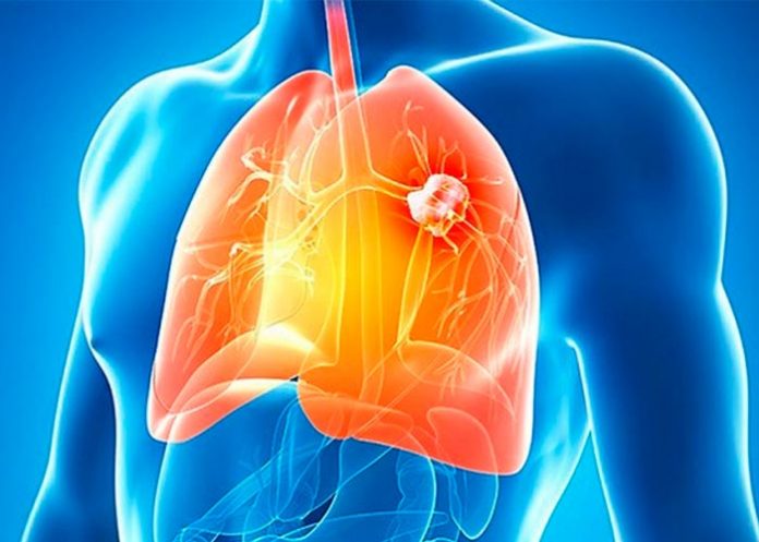 cancer de pulmon