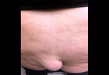 «Cola» crece en el trasero de una mujer (Fotos) cirugia