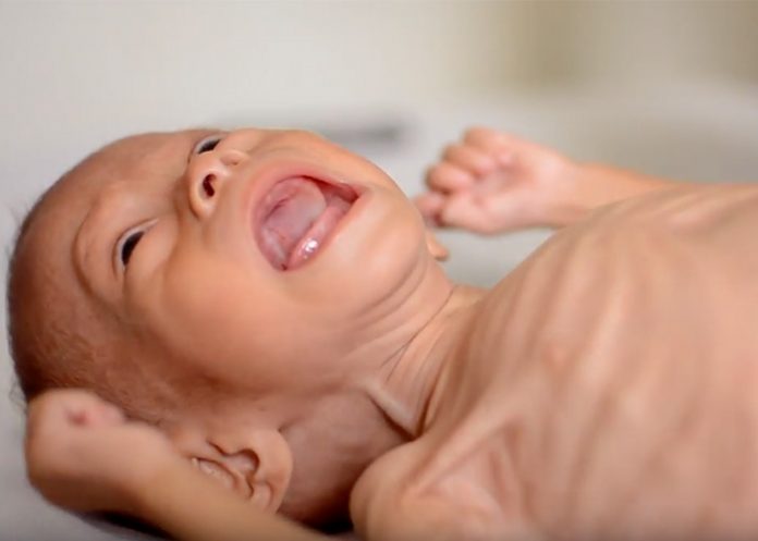 desnutricion infantil