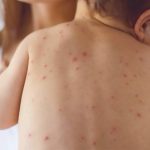 Guatemala en alerta ante la amenaza de brotes de sarampión guatemala