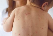 Guatemala en alerta ante la amenaza de brotes de sarampión guatemala