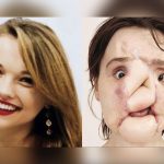 Se destruyó el rostro de un disparo y ahora es la más joven en recibir un trasplante de cara katie stubblefield