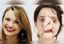 Se destruyó el rostro de un disparo y ahora es la más joven en recibir un trasplante de cara katie stubblefield