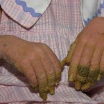 Hospitalizada hace un mes la Niña Árbol de Honduras honduras