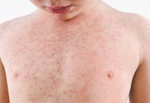 Aíslan a cuatro niños por posible sarampión en Costa Rica virus