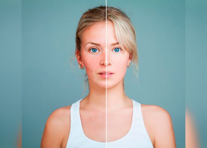 PELITO_gEAh97w enrojecimiento del rostro