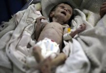 400.000 niños yemeníes sufren malnutrición severa aguda tipitapa