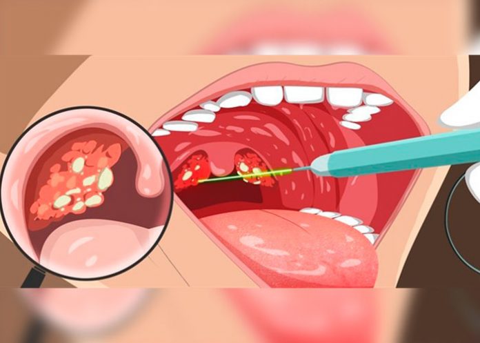 PORTADA_DdRN5XV amigdalas