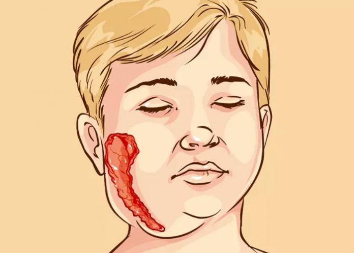 Papera-enfermedad-el-salvador el salvador