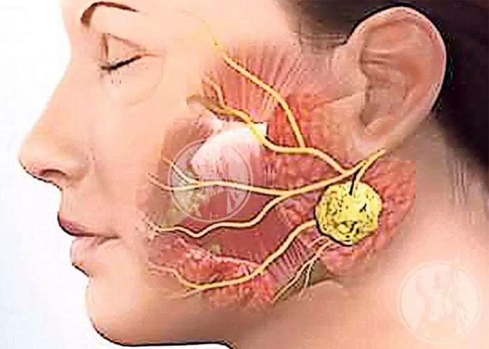 Paperas-El-Salvador el salvador