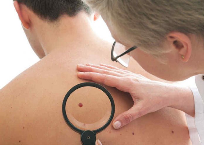 Sin-titulo-1_UE9N1N5 melanoma