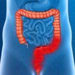 colitis