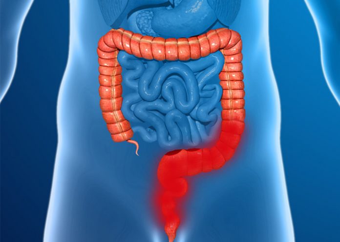 colitis