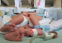 Honduras: Nacen siamesas unidas por órgano vital honduras