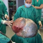 Costa Rica: Médicos extirpan con éxito tumor de 34 kilos a paciente de Tibás