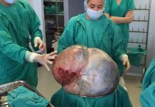 Costa Rica: Médicos extirpan con éxito tumor de 34 kilos a paciente de Tibás