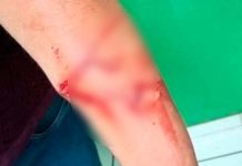 brazo apunalado
