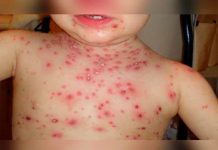 Alerta en Perú tras muerte de niño por falta de vacuna contra la varicela