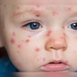 Alerta en México por tres casos de sarampión bebe con sarampion