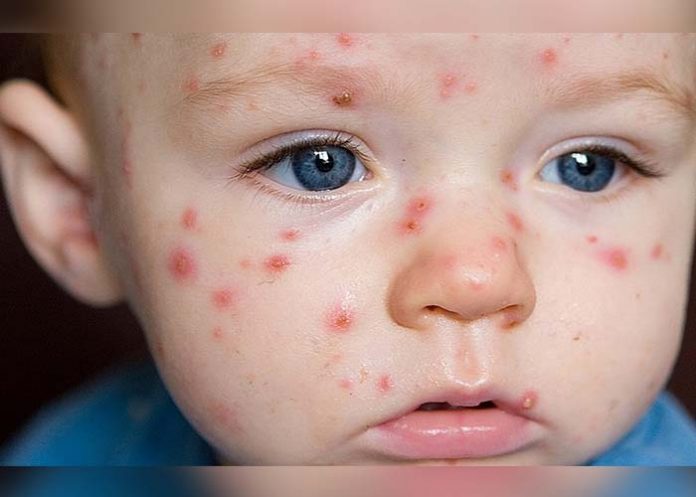 bebe con sarampion