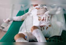 Argentina: Peruana le prende fuego a su marido por infiel hombre quemado