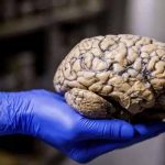 México: Expertos salvan la vida a paciente al extraer meningioma gigante
