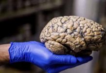 México: Expertos salvan la vida a paciente al extraer meningioma gigante