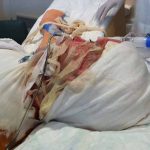 Once mujeres han muerto quemadas en menos de dos años en Perú peru