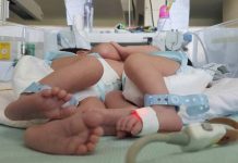 Fallecen siamesas hondureñas que compartían corazón e hígado siamesas