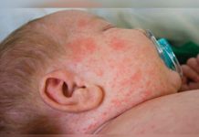 Reportan brote de sarampión en dos estados de Brasil bebe