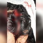 Costa Rica: Niña sobrevive a brutal ataque de perro pitbull costa rica