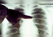 Mujer fallece de cáncer tras recibir trasplante de pulmones de fumadora placa