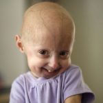 Viral el caso de niña hondureña con síndrome de Button, tiene 5 y parece de 80 honduras