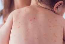 Costa Rica alerta sobre expansión de sarampión en América nino