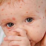 Aumenta a tres los casos confirmados de sarampión en Argentina bebe