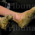 Reportan primer caso de «Niña Árbol» en Centroamérica nina arbol