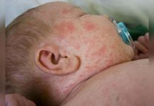 Ministerio de Salud confirma dos casos de sarampión en Argentina bebe