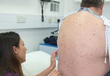 ¡Asco! Este hombre es el papá de los puntos negros y las espinillas estados unidos
